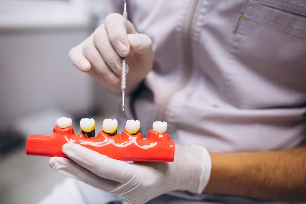 dental implants | dr ryan kaltio dental clinic