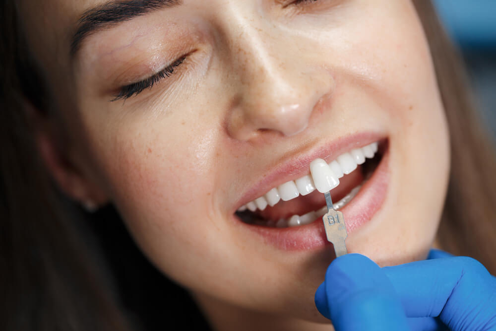 porcelain veneers | dr ryan kaltio dental clinic