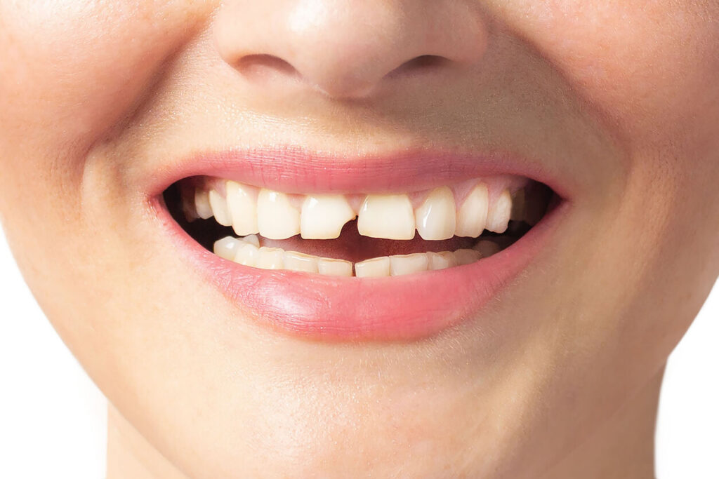 broken upper incisor in a woman mouth
