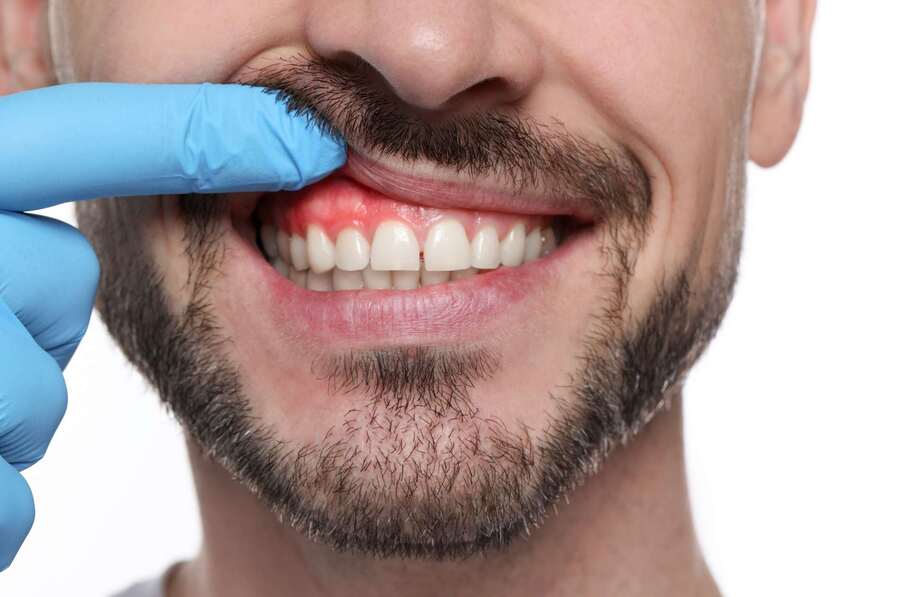 Don’t Ignore the Gums: The Warning Signs of Gum Disease