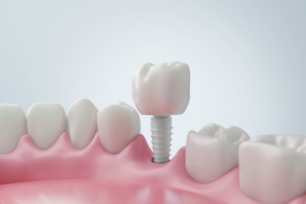 Complete Guide to Dental Implants