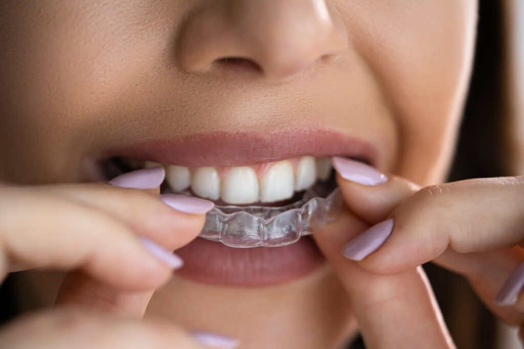 Invisalign